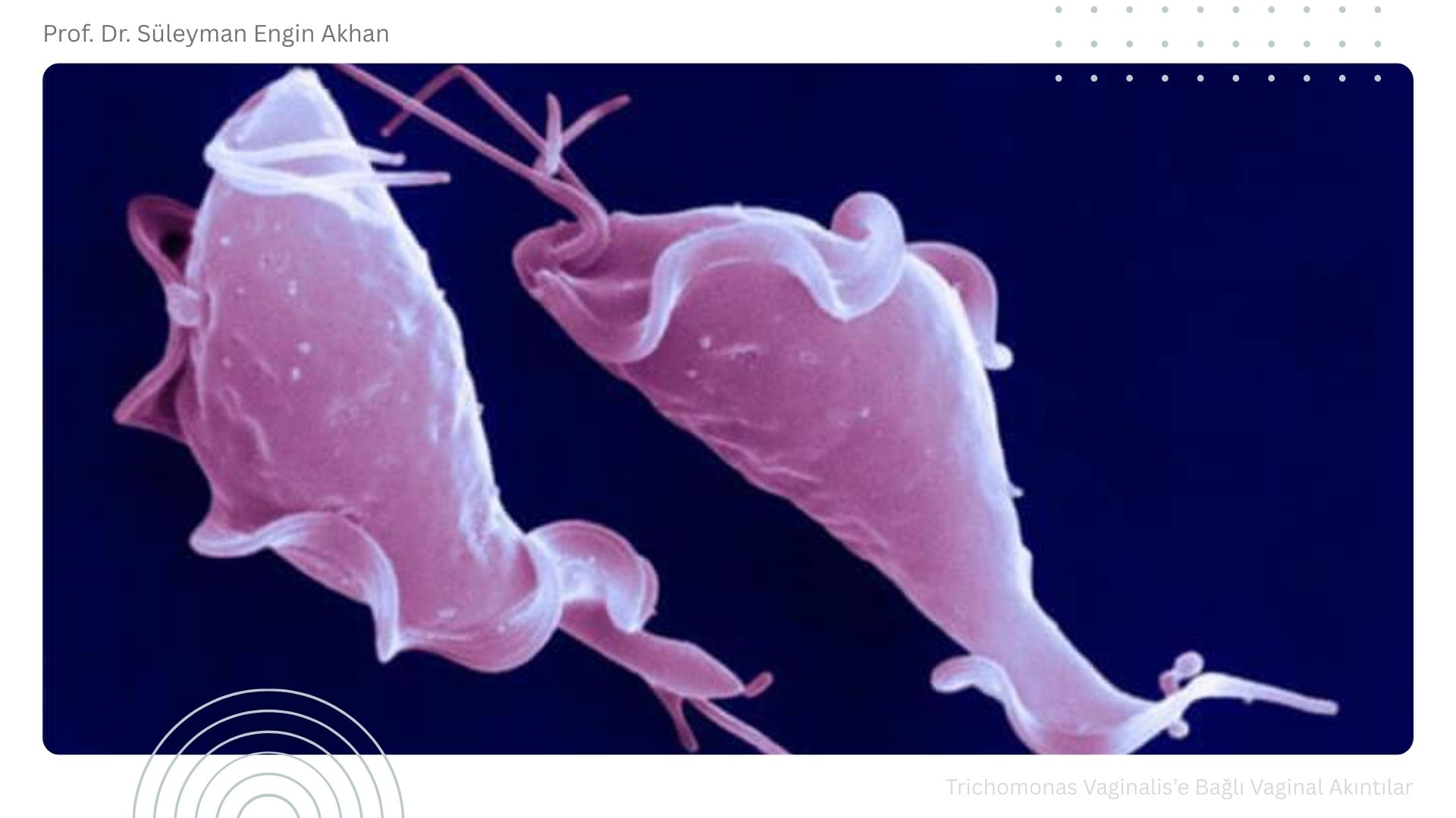 Trichomonas Vaginalis'e Bağlı Vaginal Akıntılar